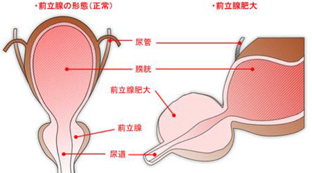 如何治疗前列腺肥大
